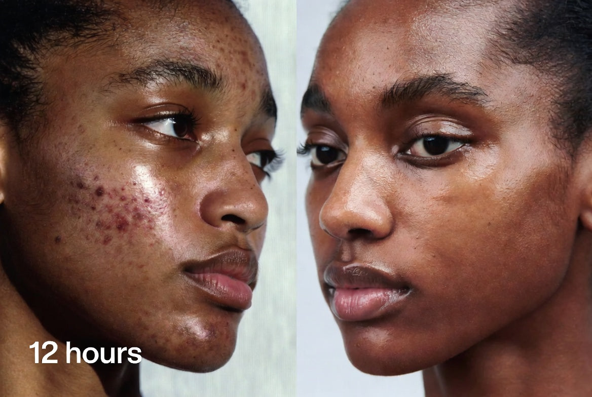 Mooyam Gel Anti-Acné
