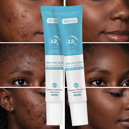 Mooyam Gel Anti-Acné