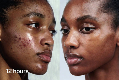 Mooyam Gel Anti-Acné